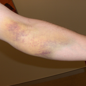 Why are so many patients arms bruised after blood collection?